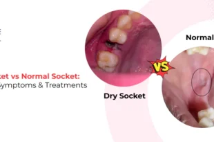 Dry Socket vs Healthy Socket: Symptoms Explained